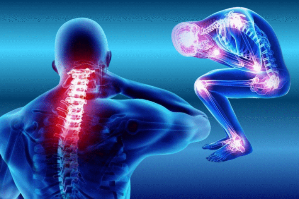 fibromialgia