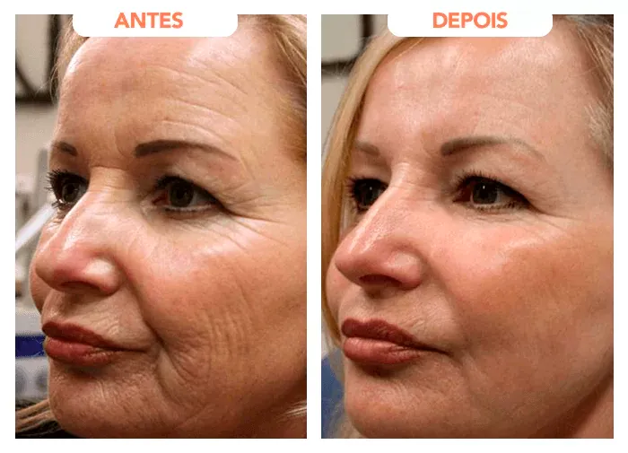 retinol-antesx-depois-jpg Como Reduzir Celulite: Métodos Comprovados Pela Ciência